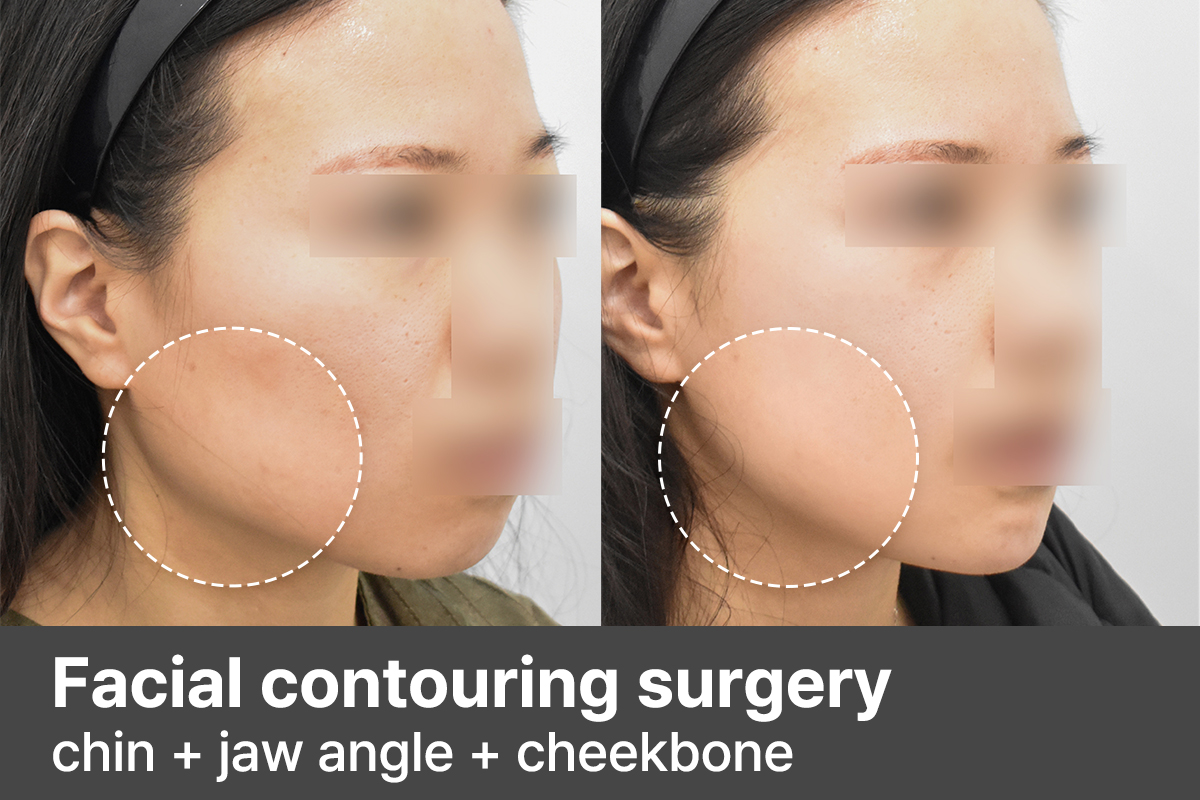 Before & After: Korean V-Line Surgery (Cheekbone, Jawline & Chin Contouring)