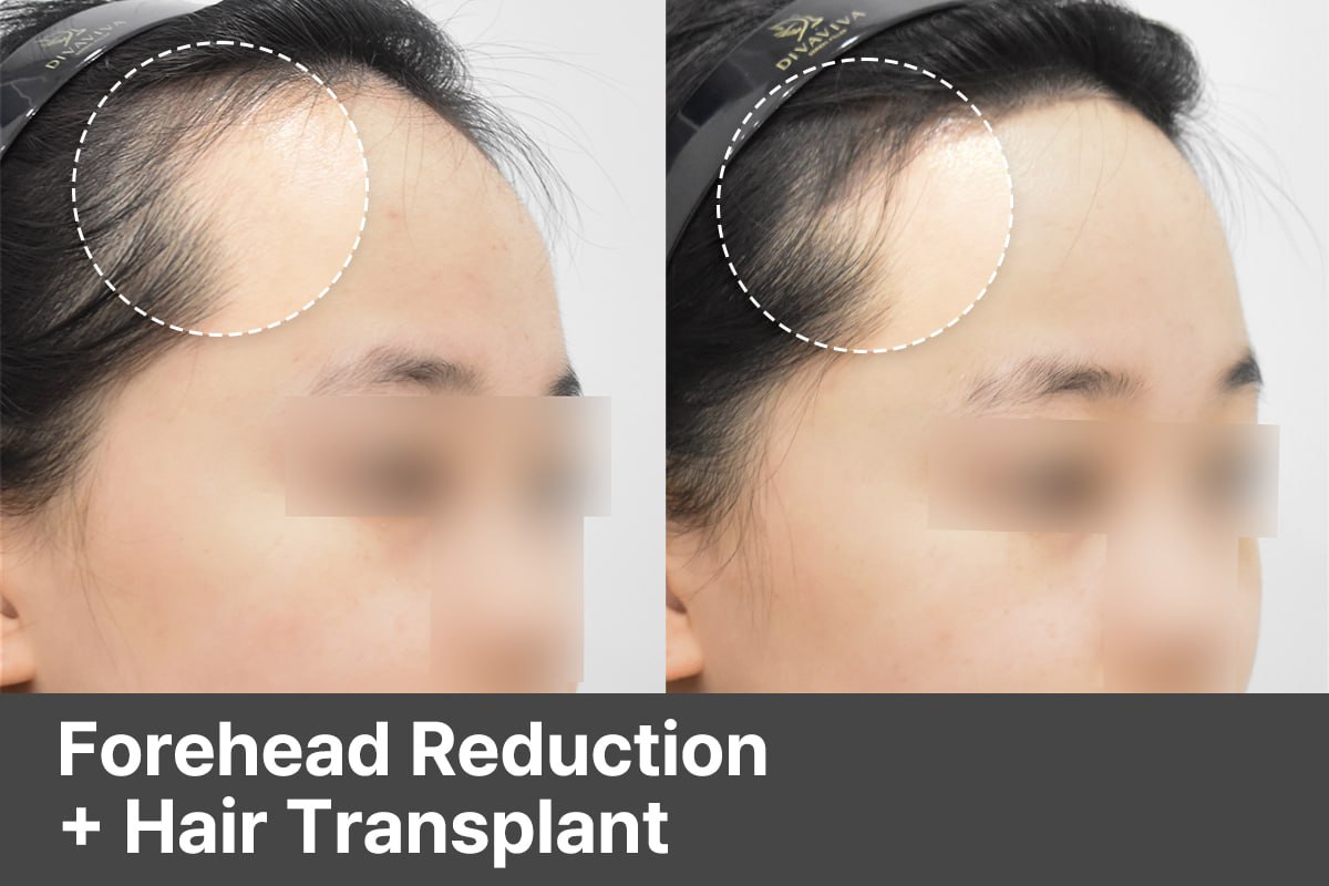 Forehead Reduction with Hair Transplant in Korea