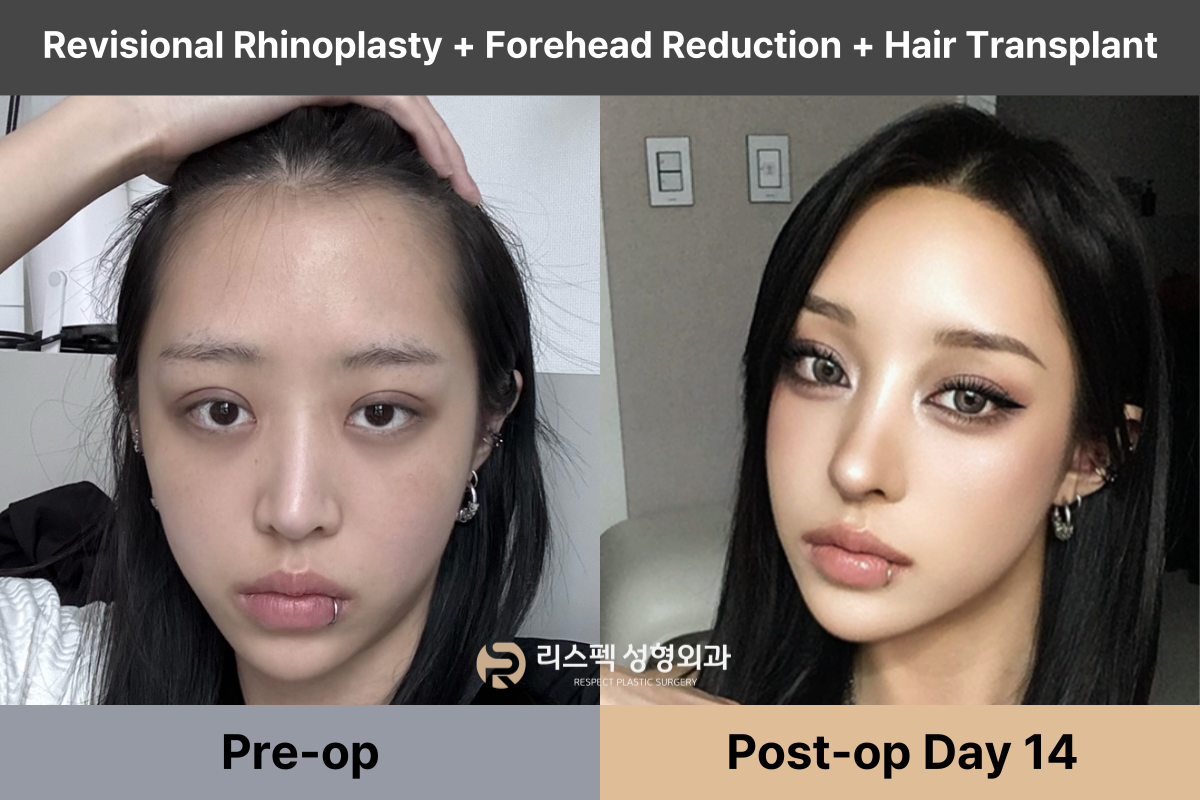 Real Patient Review｜Forehead Reduction + Hair Transplant + Revision Nose Tip Surgery (2 Weeks Post-Op)