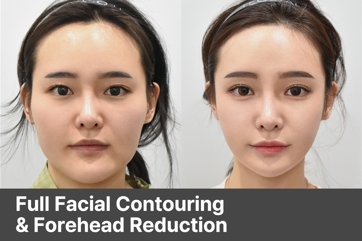 Combined Facial Contouring & Forehead Surgery Featuring Hairline Lowering, Brow Lift, M-shaped Hair Transplant, and 3-Point Bone Reduction