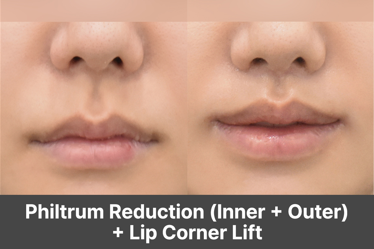 Everything You Need to Know About Philtrum Reduction Surgery (Inner, Outer & Scarless Techniques)