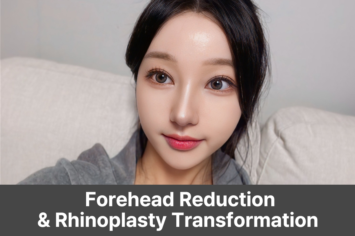 Forehead Reduction + Rhinoplasty Real Review | 1-Month Before & After Results (Respect Plastic Surgery)